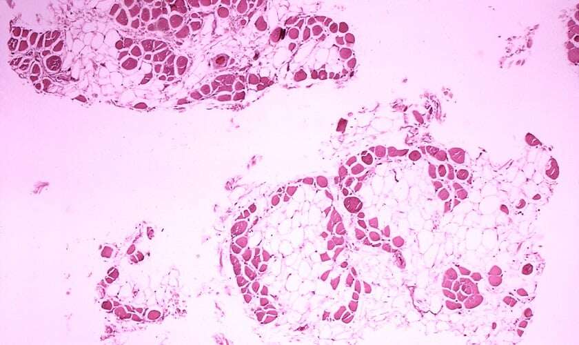 Image shows muscle tissue affected by muscular dystrophy. 